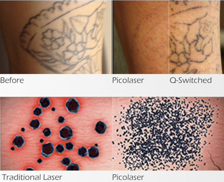 factory produced best korea lab all colors pico laser tattoo remover with Picosecond