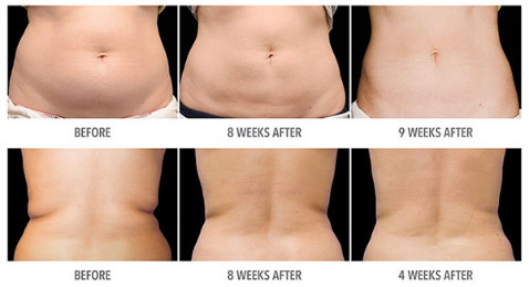 Fat Freeze Cryolipolysis Body Slimming Machine Fat Burning Equipment With Cooling Technology