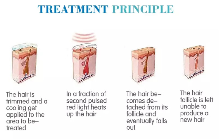 best hair removal system 808 diode laser hair removal machine for sale