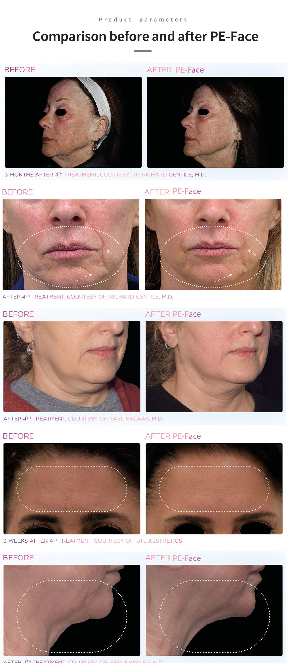 EM-Face RF Wrinkle Removal Face Lifting Tighten Slim face machine Non-invasive Weight loss Machine For Salon