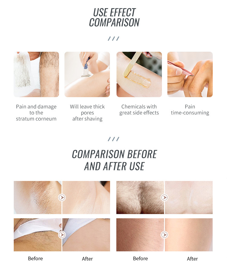 Xenon Flash Depiladora Ipl Opt Shr Laser Machine for Vein Removal