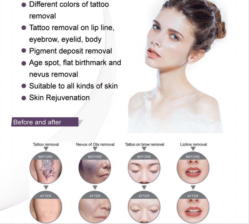 Q Switched ND YAG Laser Tattoo Removal Machine For Pigment Deposit Dispelling