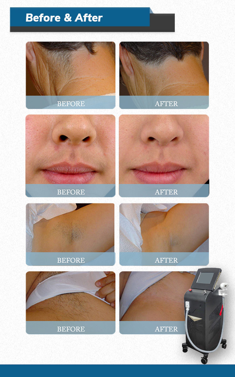 vertical professional diode laser 808nm hair removal machine / Newest Best price 808nm diode laser hair removal machine