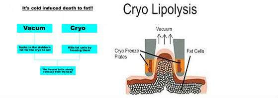 Antifreeze Membranes Cryolipolysis Slimming machine Cavitaion RF Fat Freezing Machine