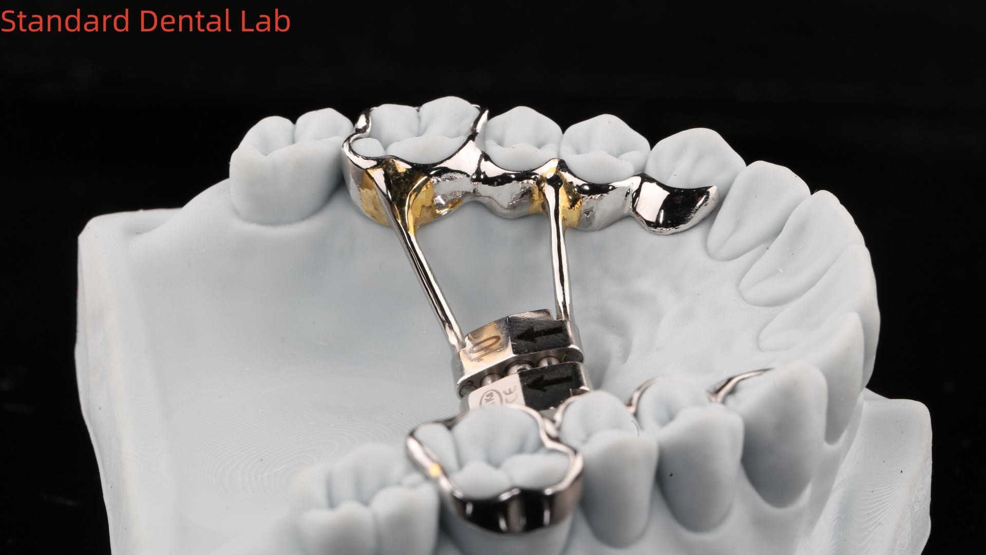 Arch Teeth Palate Expander Stable Hyrax Palatal Expander Perfect Fit SDL Dental Lab Orthodontics Appliance