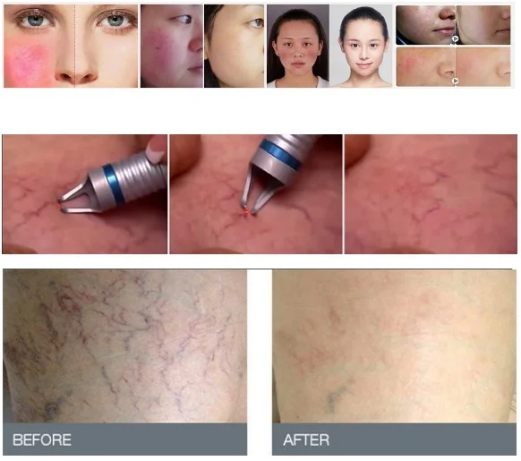 Portable Spider Vein removal / Vascular Removal 980nm medical diode laser machine