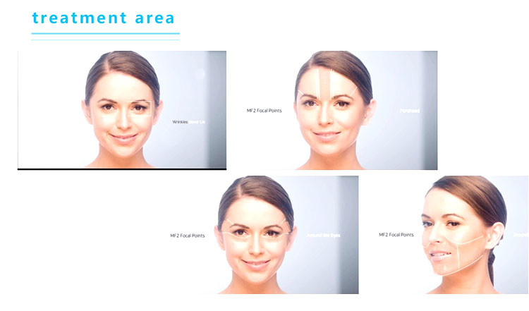 RF Non Invasive Body Contouring Machine , Anti Puffiness HIFU Korea Machine