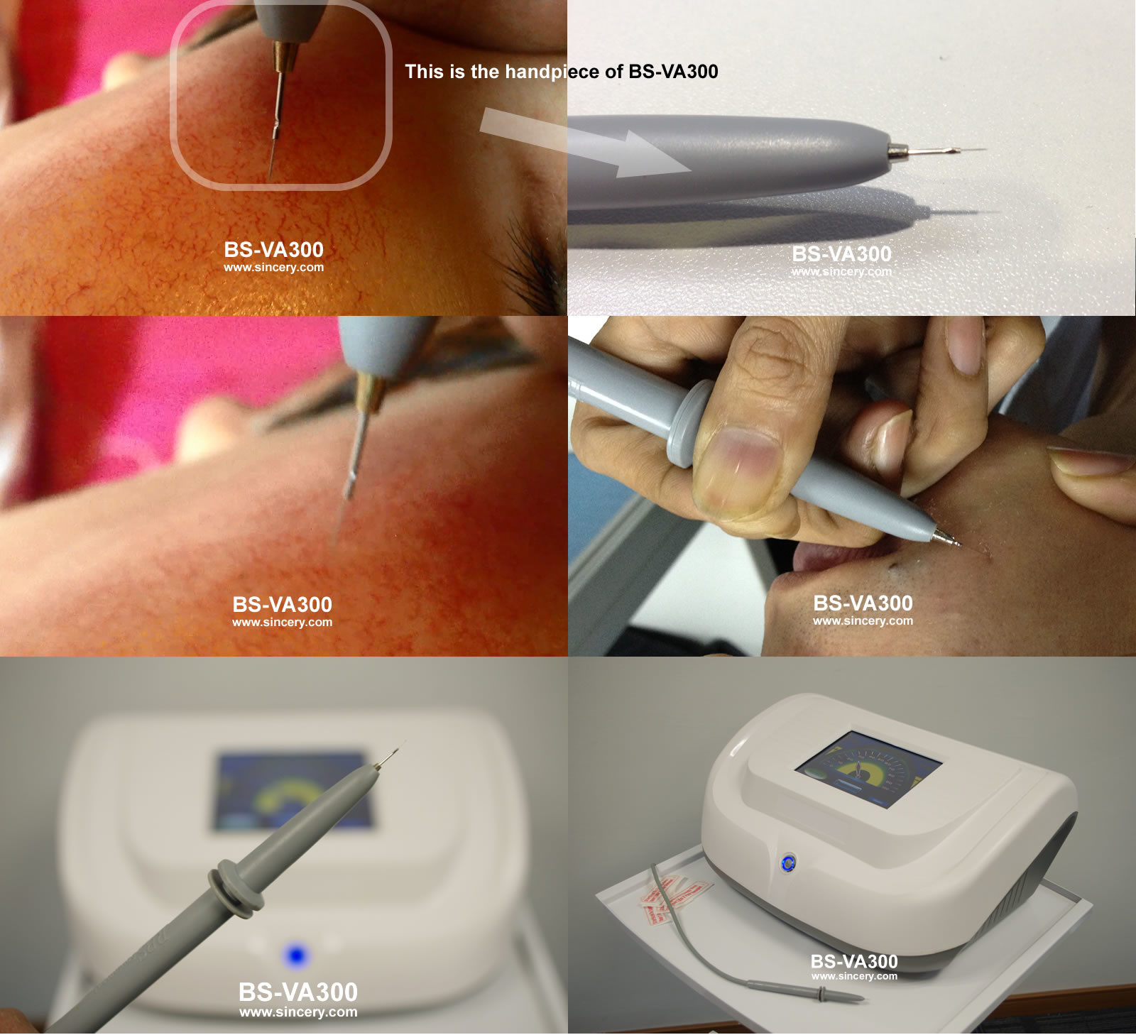 Painless 30MHz High Frequency Skin Care Machine For Spider Vein Treatment