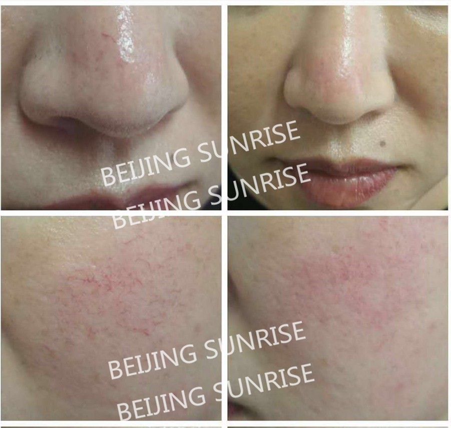 980nm diode laser for pain relief, physical therapy, nail fungus removal