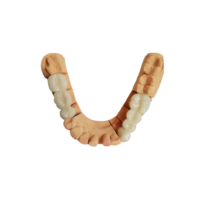 High Quality PFM Dental Crown Realistic Appearance Color Stable Not Easy To Wear