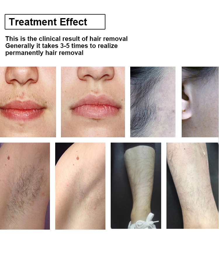 Epilation 808NM Diode Laser Machine Hair Removal Laser System