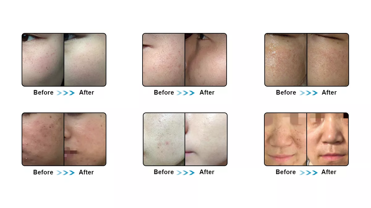 Professional IPL DPL Hair Removal Acne Treatment Skin Rejuvenation Removal Device Permanent Hair Removal Machine