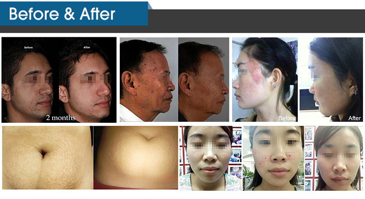 Salon Fractional CO2 Laser Machine Air Cooling For Acne Removal