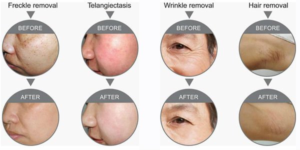 Home Use IPL Laser Hair Removal Machine Vertical For Skin Rejuvenation