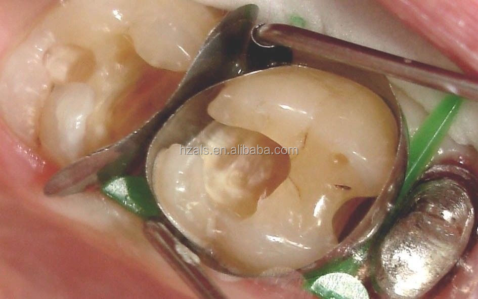 1.298 TOR VM PROFESSIONAL DENTAL Filling Materials Advanced Kit of Sectional Contoured Matrices for MFDS Safety Standard