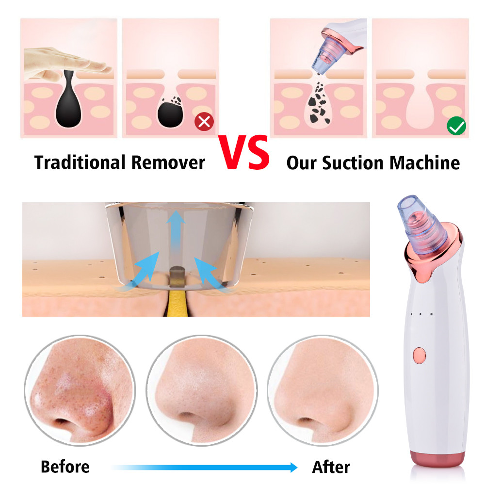 Blackhead Remover Vacuum Acne Whitehead Cleaner with USB Charger by New Brand