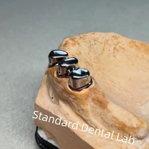 High Esthetics CAD CAM Tooth Partial Denture Attachment Replacement Standard