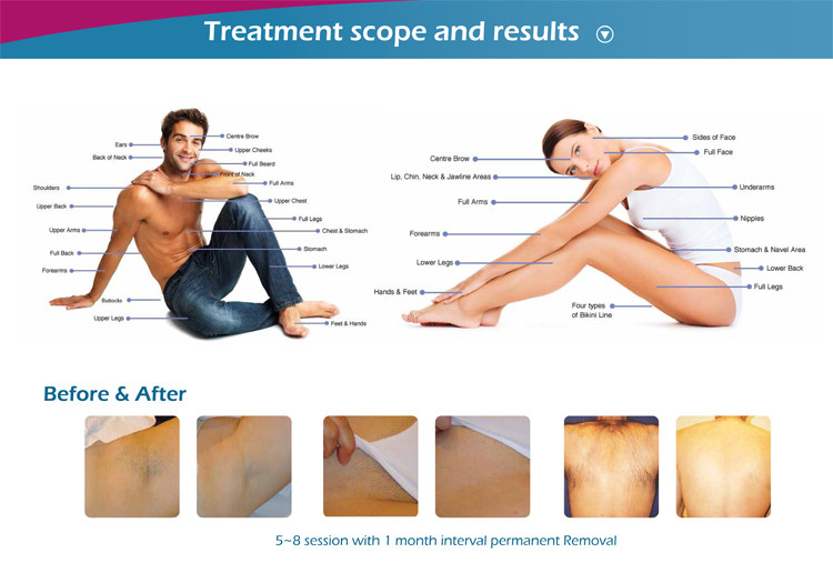 808nm diode permanent soft light soprano laser hair removal machine for sale uk