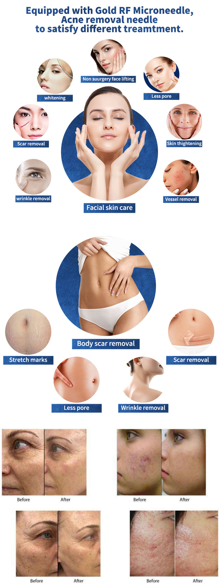 GOMECY Microneedling Radiofrequency Machine , Microneedle Fractional RF System
