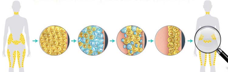 Professional 4 hands cryolipolysis cool body sculpting machine fat freezing slimming machine 360 degree for double chin 