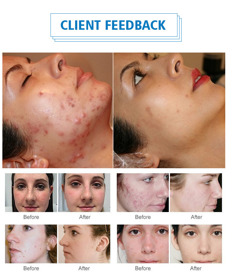 Customizable PDT Machine With 1500PCS LEDs For Skin Rejuvenation Treatment