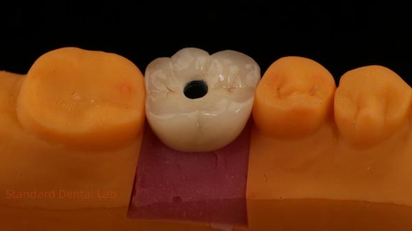 Screw Retained PFZ Porcelain Layered Zirconia Dental Implant Crown from Dental
