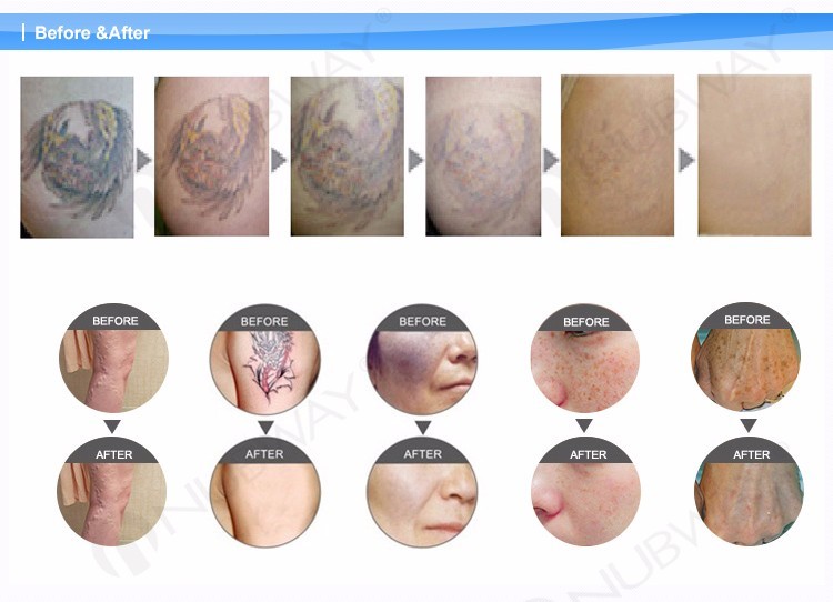 Lowest price from manufacture sapphire ruby laser tattoo removal machine