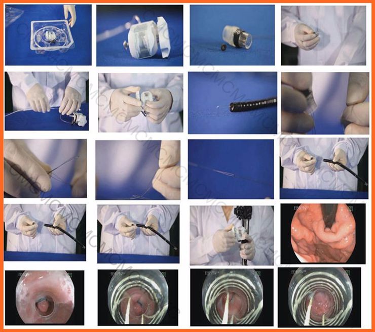 Ligatures endoscopic loop of variceal bands