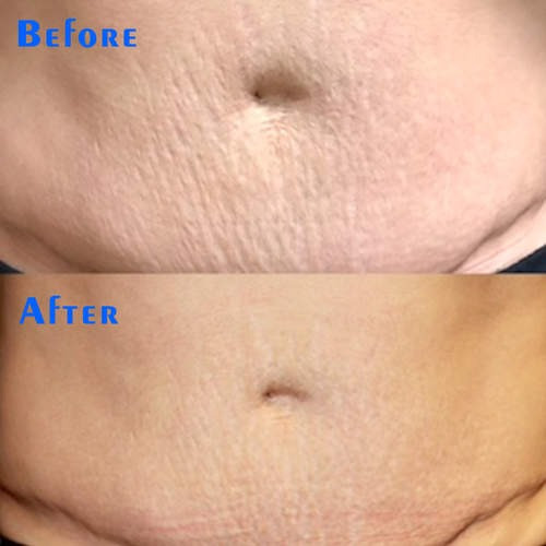 Cosmetic Repair Microneedle Radiofrequency Device No Insulation Plating