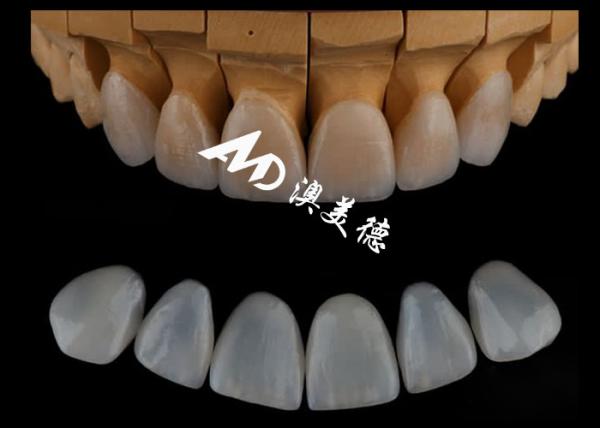 Highly Accurate Customized Emax Veneers/porcelain Dental Veneer For Cosmetric