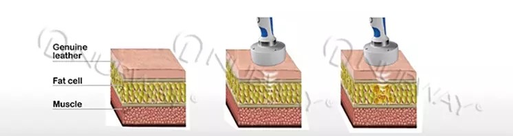 Most Advanced Non-Invasive HIFU Cellulite Ultrasonic Slimming Machine