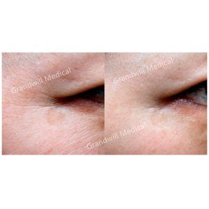 Stimulating Collagen PCL Skin Booster Syringe Polycaprolactone Based 2ml