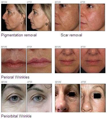 Bison Fractional CO2 Laser vertical co2 fractional laser machine Laser Resurfacing