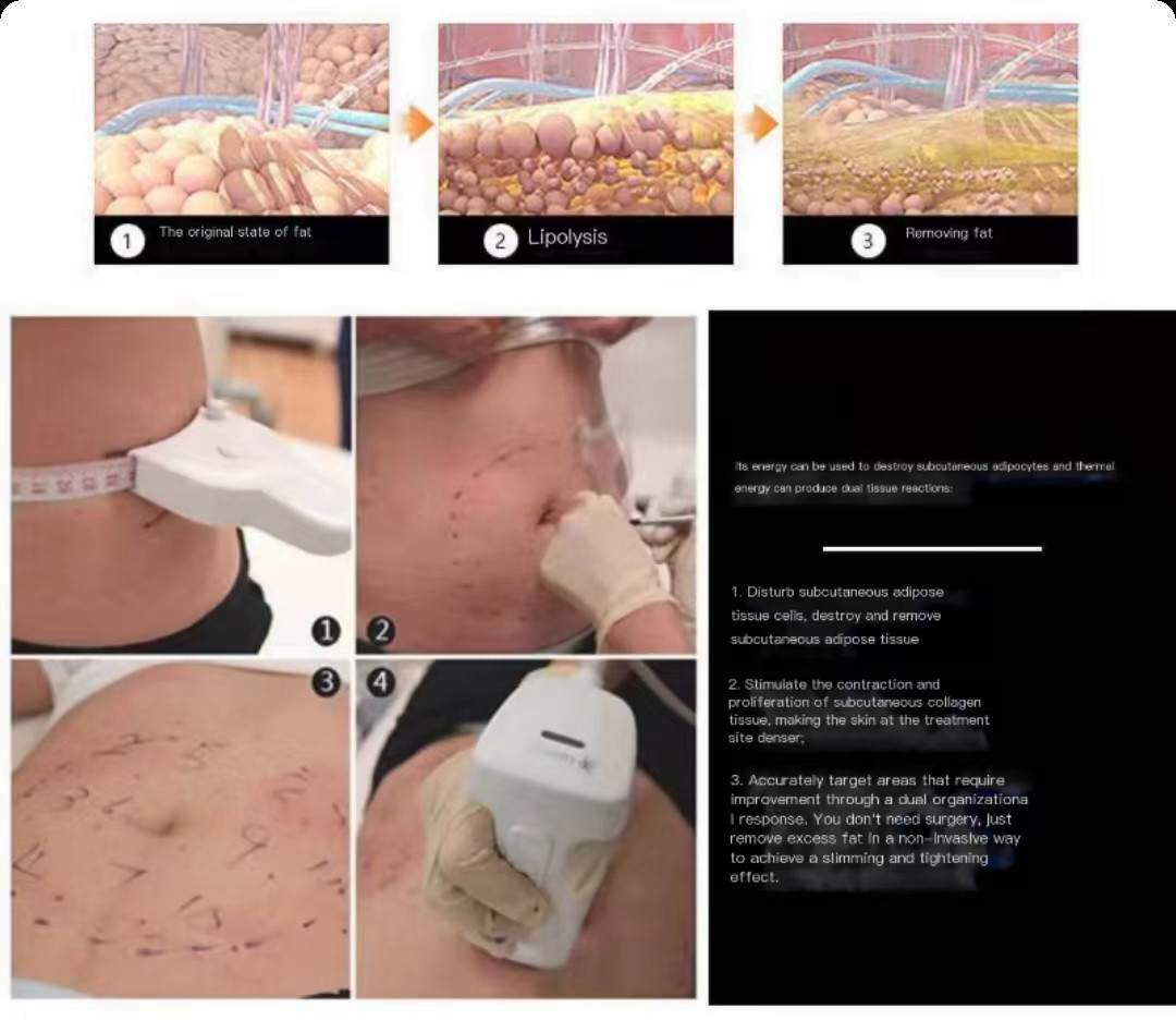 Liposonic Ultrasound HIFU Beauty Machine 0.8cm 1.3cm Cellulite Reduction