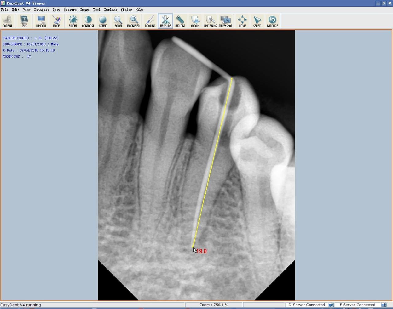 Vatech EZ Portable South Korea Digital Dental X Ray Sensor Ezsensor