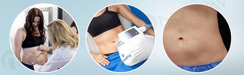 New design painless confortable treatment vacuum cavitation system cryolipolysis cool shaping slimming machine