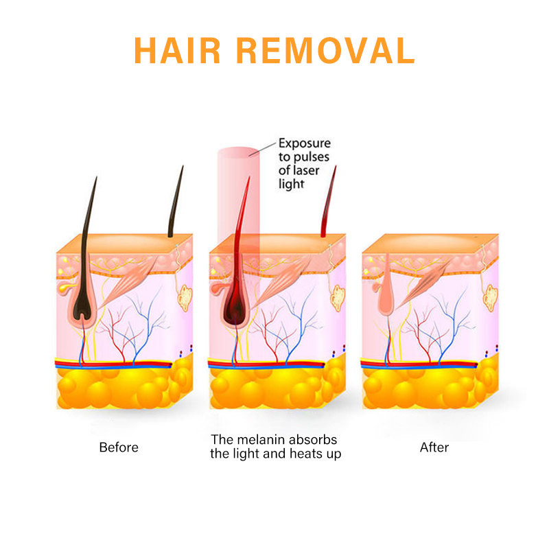 Skin Rejuvenation 1200W IPL Hair Removal Machine 530nm To 1200nm