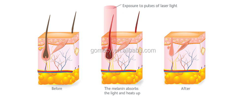 Ipl + E-light + Shr 3 In 1 System Ipl Photofacial Machine For Home Use Ipl E-light Shr Laser Hair Removalskin Rejuvenation.png