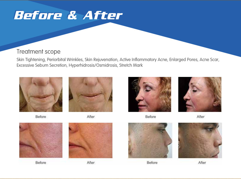 laser wrinkle removal face lifting micro needle fractional rf machine