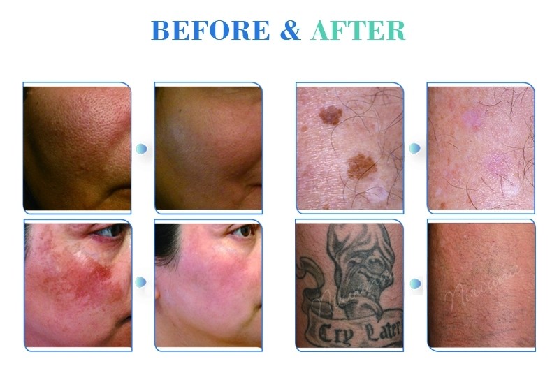 2019 1064nm + 532nm + 755nm Picosecond q switched nd yag laser