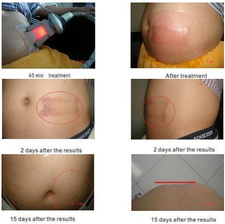 40% Off the most featured Cryolipolysis Slimming Machine Green Vertical