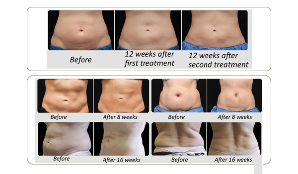 Portable high quality advanced slimming machine/ cavitation rf machine