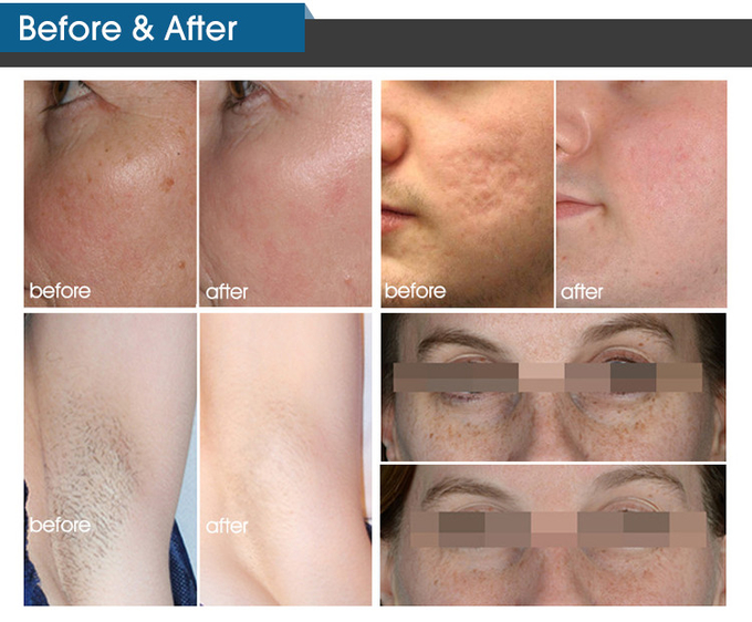 Skin Rejuvenation Ipl Laser Machine 240v / 10 Mhz Power Supply