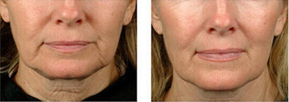 50Hz - 60Hz 3D HIFU Machine High Intensity Focused Sound Machine Effective For Wrinkle Removal