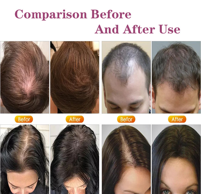 New Metal Teeth Design Hair Loss Treatment Ems Laser Vibration Massage Electric Hair Regrowth Comb With Liquid Guide