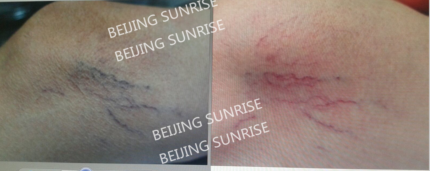 980nm diode laser for pain relief, physical therapy, nail fungus removal