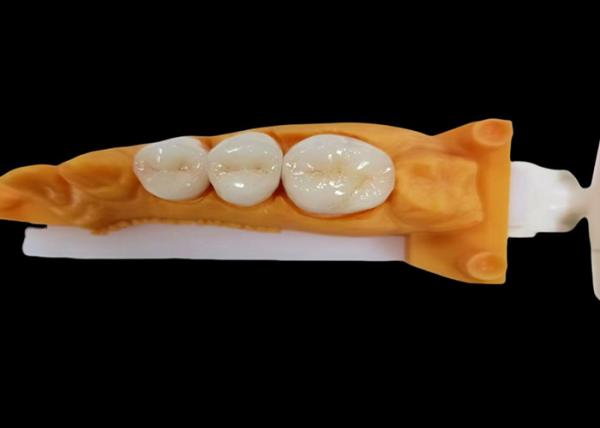 Wear-Resistant Zirconia Dental Crown with Chip and Stain Resistance and Natural