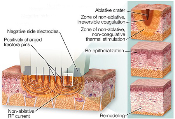Secret microneedle fractional rf system microneedle fractional radiofrequency