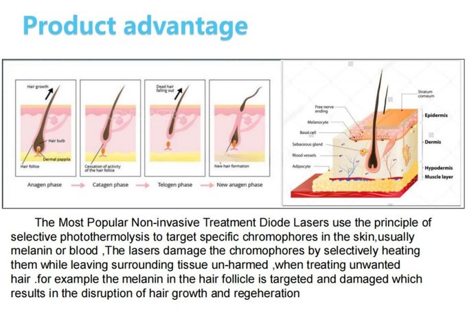 Fast and Efficient Diode Laser Hair Removal Machine for Men and Women 1