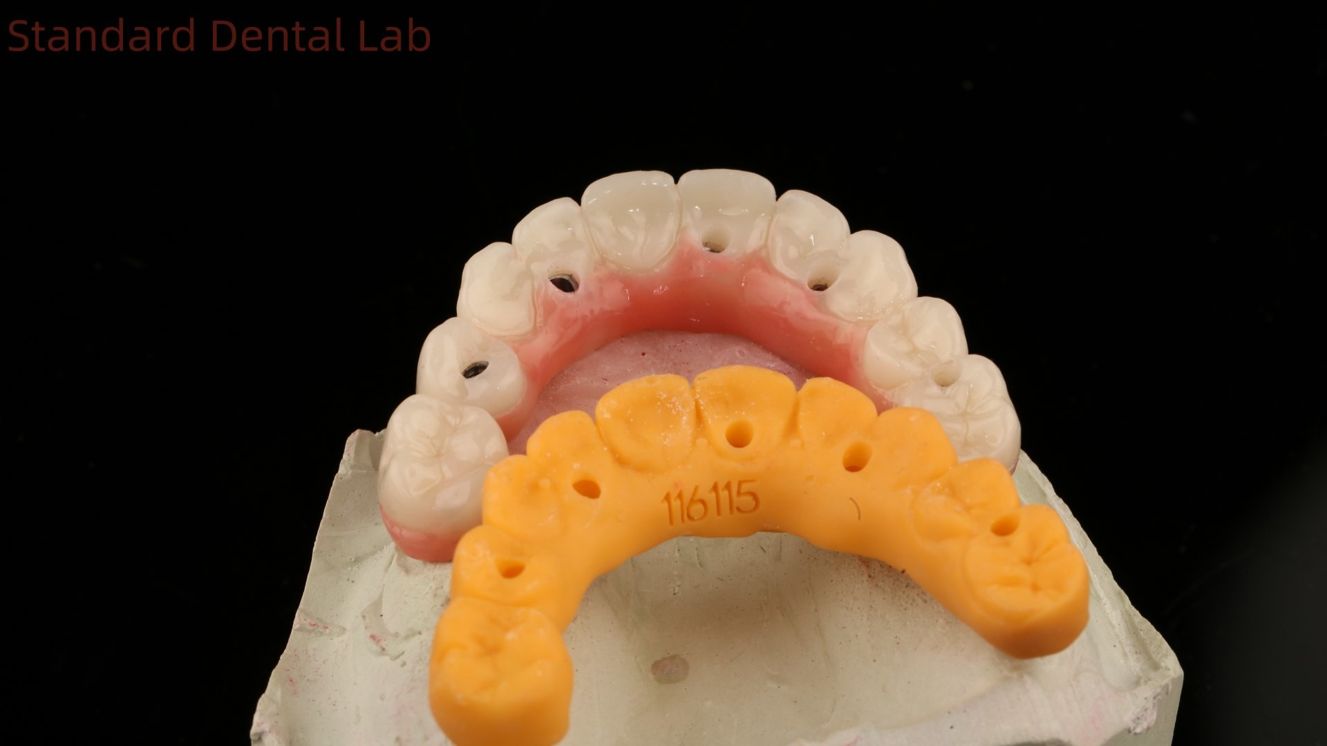 5 Year Guarantee Dental Implant Crown PMMA Bridge Over Multi Unit Abutments Customized Vita Shade